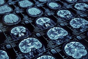 AlzeCure Pharma publishes response letter clarifying Alzstatin’s distinct mechanism in Alzheimer’s treatment