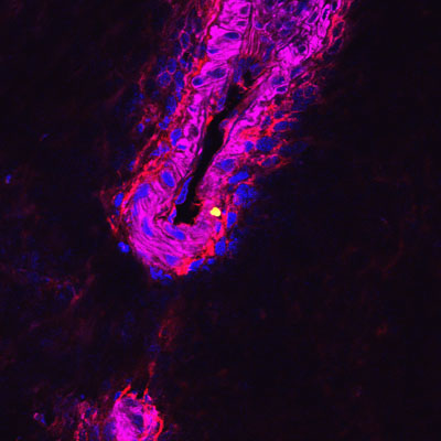Antimicrobial therapy can prevent sepsis in pneumonia patients