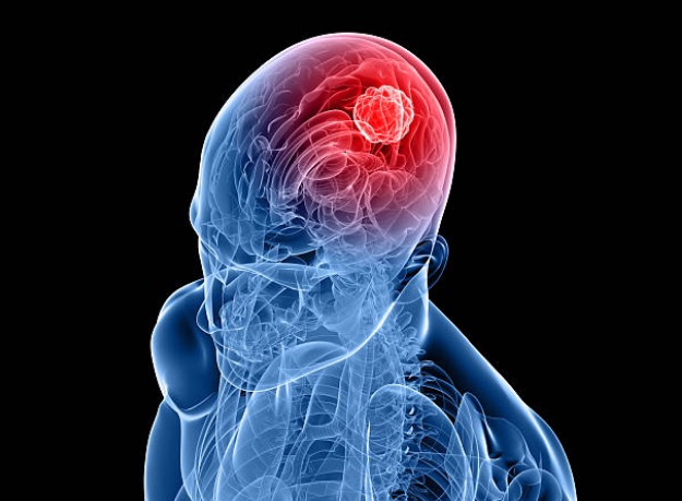 Virus could treat brain tumours by boosting immune system