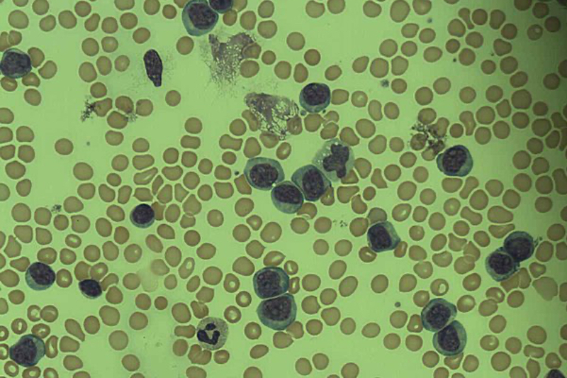 Autolus Therapeutics' CAR-T therapy, Aucatzyl, bags FDA approval for ALL