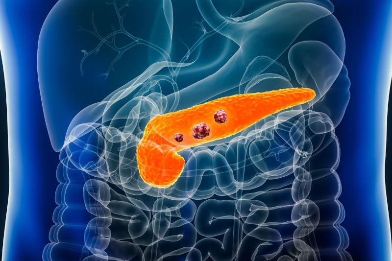 BetaGlue Therapeutics gains MHRA approval for pancreatic cancer trial