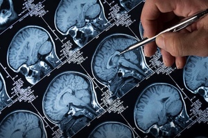 Biogen and Neurimmune announce option exercise for Aducanumab