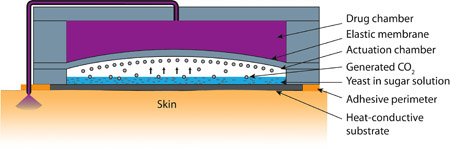 Body heat used to drive new drug micropump