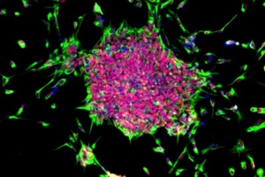 Censo and Leeds University create iPSCs from cancer tissue