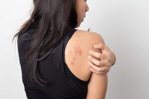 CHMP recommends Sanofi and Regeneron’s Dupixent to treat chronic spontaneous urticaria in EU