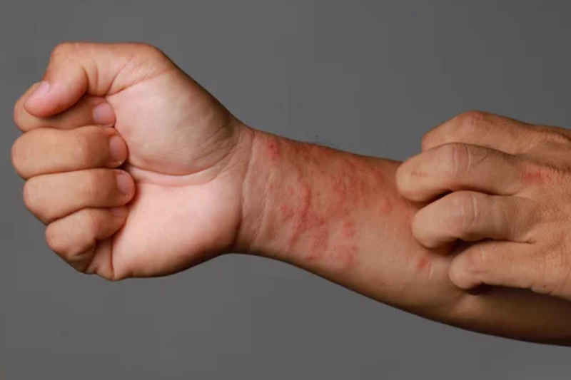 Galytx and dermatology biotech Quodria to develop atopic dermatitis treatments