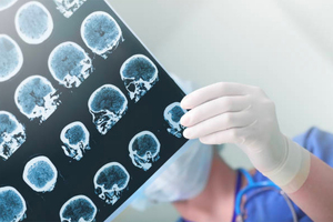 Genetic study of epilepsy points to potential new therapies