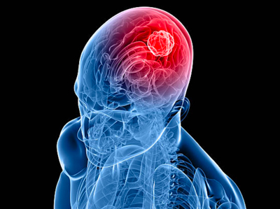 Global glioblastoma market set to reach $1.4bn by 2027