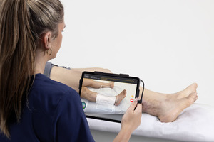 Hamilton Health Sciences chosen for BirchBioMed burn scar treatment trial