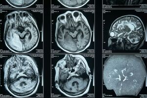 Harness Therapeutics and Ovo Venture Investment team up to launch R&D programme for rare neurodegenerative disorder