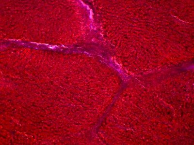 Liver cancer space could be invigorated says GBI Research 