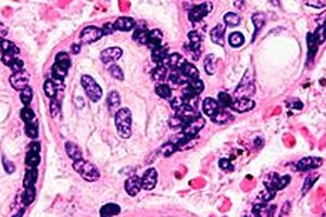 MediSieve to take blood filtration research into fight against leukaemia