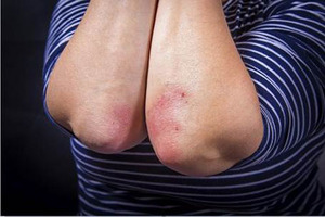Molecule discovery holds promise for gene therapies for psoriasis