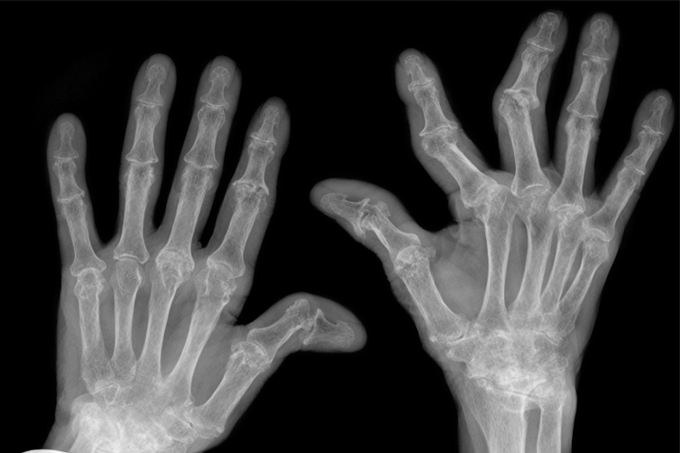 New therapeutic target for rheumatoid arthritis