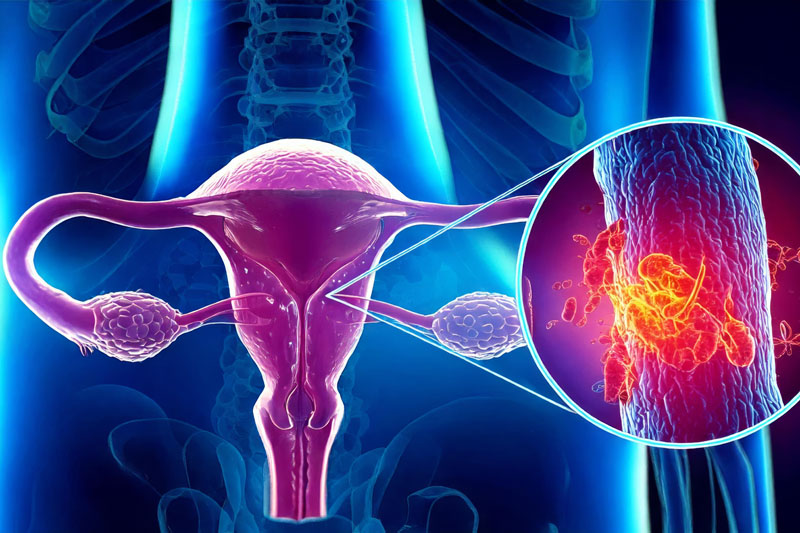 NICE recommends MSD’s KEYTRUDA with carboplatin and paclitaxel for endometrial cancer