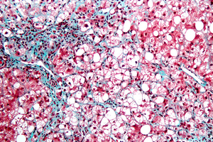 Non-alcoholic steatohepatitis market to increase more than fortyfold by 2026