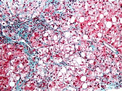 Non-alcoholic steatohepatitis market to increase more than fortyfold by 2026