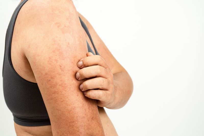 Novartis secures FDA approval for Rhapsido, the first oral BTKi treatment for chronic spontaneous urticaria