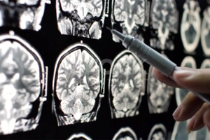 PharmaKure and Universiti Teknologi MARA (UiTM) announce Alzheimer’s partnership
