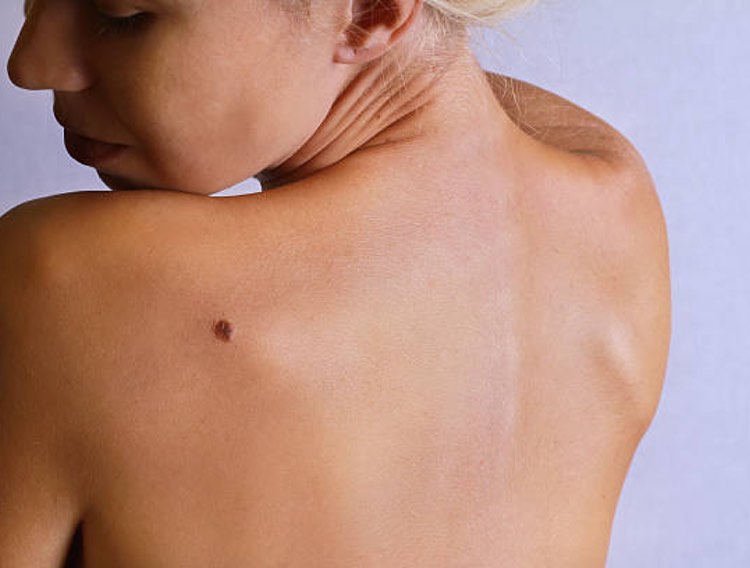Report highlights link between the microbiome and melanoma