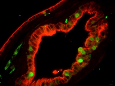 Research identifies cells potentially linked to prostate cancer recurrence