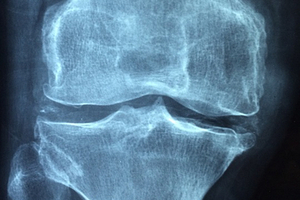 Rheumatoid arthritis market to hit $28.5bn by 2025
