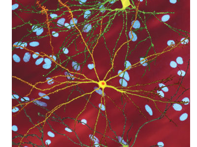 Scientists to develop life-transforming drugs for Huntington’s disease sufferers 