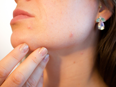 SPIE Photonics West to present new method for visualising minocycline delivery in skin