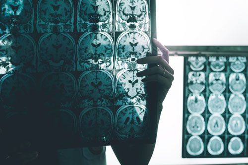 Study with Aptar’s nasal delivery system validates insulin spray for direct-to-brain Alzheimer’s drug