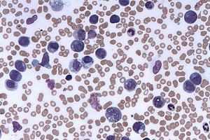Syndax Pharmaceuticals' leukaemia drug Revuforj bags FDA approval
