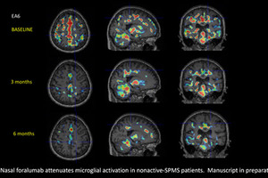 Tiziana announces positive PET scan results with intranasal Foralumab in patients with na-SPMS