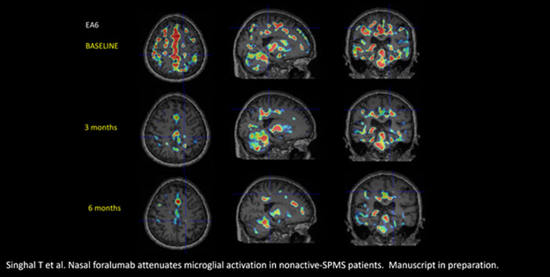 Tiziana announces positive PET scan results with intranasal Foralumab in patients with na-SPMS