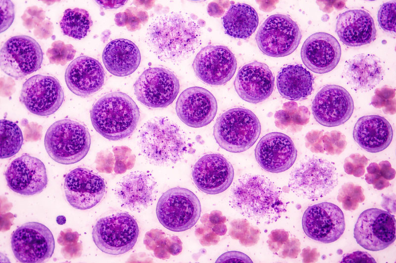 University of Sussex research reveals how leukaemia cells evade treatment