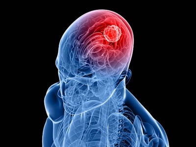 Virus could treat brain tumours by boosting immune system